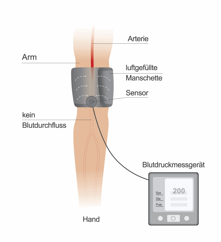 Blutdruck-Messung: Aufpumpen der Manschette
