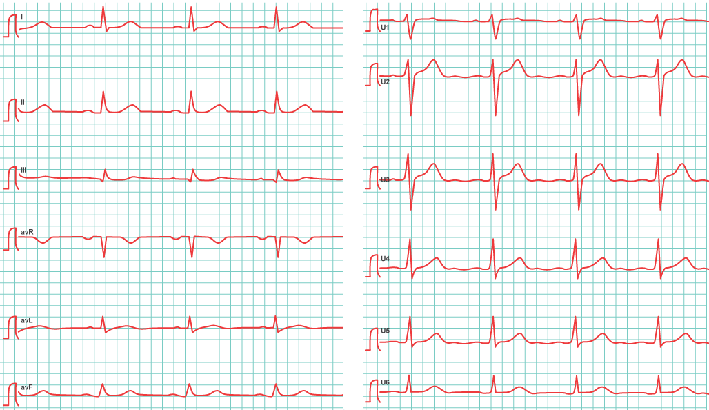 12-Kanal-EKG